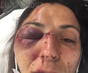Attivista No Tav ferita da un lacrimogeno, ora è in ospedale: la questura si difende