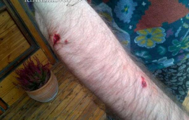 Aggredito dal rottweiller nel bosco